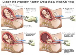 aborto dilatazione estrazione