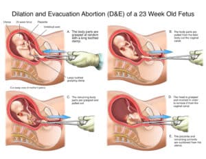 aborto 3 trimestre