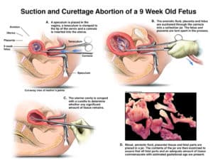 aborto 9 settimane