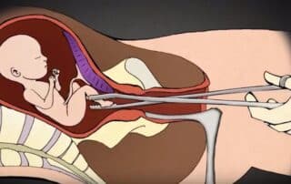 Aborto smembramento