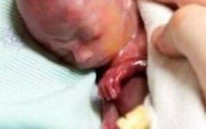 Embrione aborto